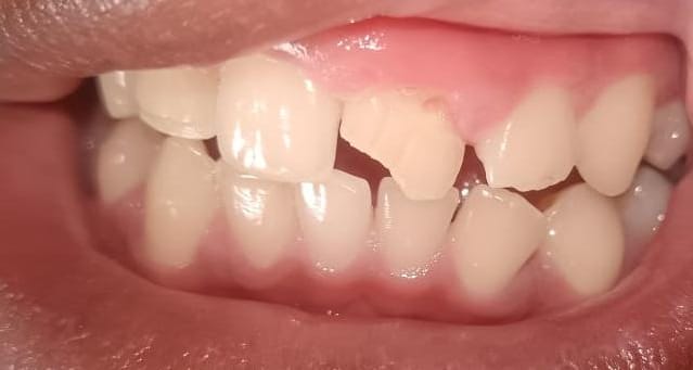 Before dental restoration