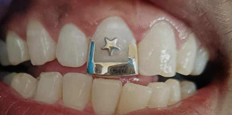 After gold installation treatment