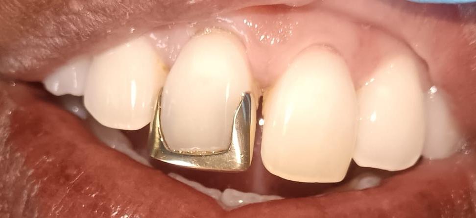 Before gold removal treatment