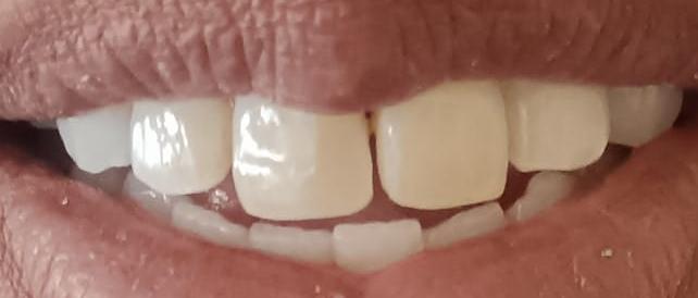 After gold removal treatment